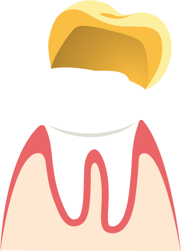 Eine künstliche Krone für den Zahnstumpf Veranschaulichung der Funktionsweise von Kronen