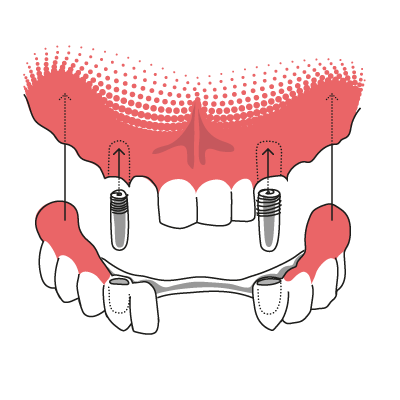 Teleskopprothese auf Implantaten Veranschaulichung der Funktionsweise einer Teleskopprothese, die auf Zahnimplantaten befestigt wird.
